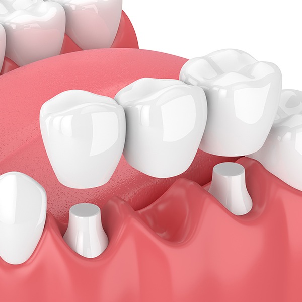 Dental Bridge | Kingsland Family Dental Centre | SW Calgary | General Dentist