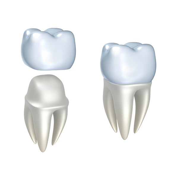 Dental Crown | Kingsland Family Dental Centre | SW Calgary | General Dentist