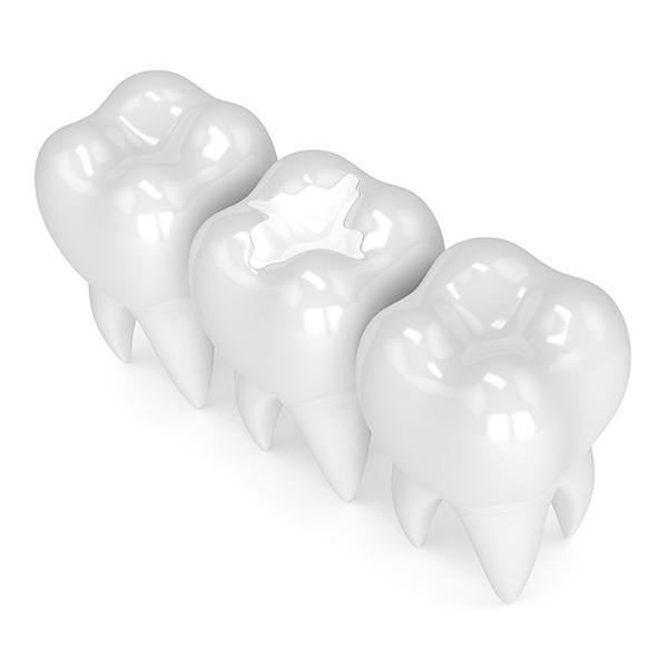 Tooth Coloured Fillings | Kingsland Family Dental Centre | SW Calgary | General Dentist