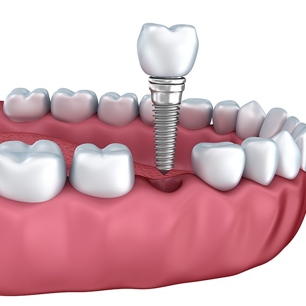 Dental Implants | Kingsland Family Dental Centre | SW Calgary | General Dentist