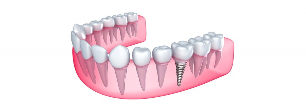 Dental Implants | Kingsland Family Dental Centre | SW Calgary | General Dentist