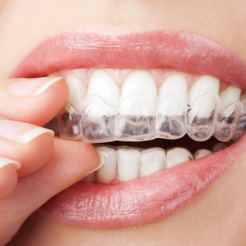 Invisalign Clear Aligners | Kingsland Family Dental Centre | SW Calgary | General Dentist