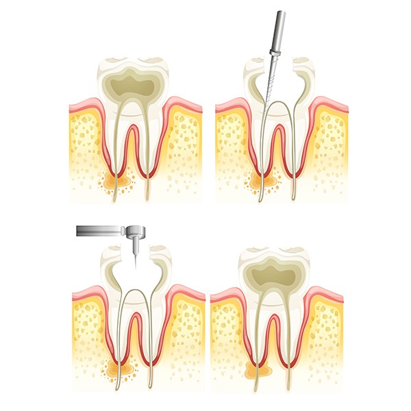 Root Canal Therapy | Kingsland Family Dental Centre | SW Calgary | General Dentist