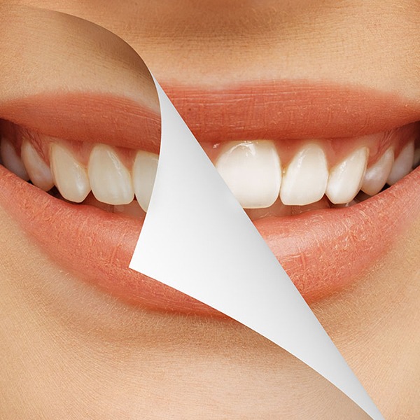 teeth-whitening-kingsland-family-dental-care-sw-calgary-general-dentist Teeth Whitening | Kingsland Family Dental Centre | SW Calgary | General Dentist